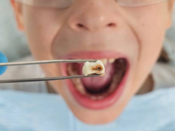 Best Emergency Dental Care for Broken or Chipped Teeth in South Portland, ME