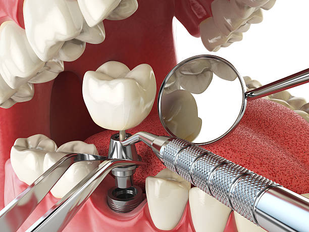 Best Emergency Tooth Extraction in South Portland, ME